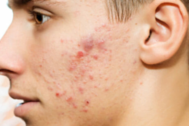 Acne and Acne Scars