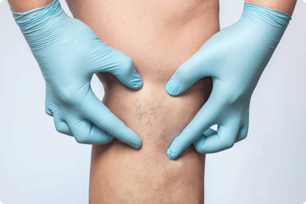 hands in medical gloves viewing spider veins on patient's leg