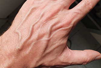 puffy varicose veins on hand