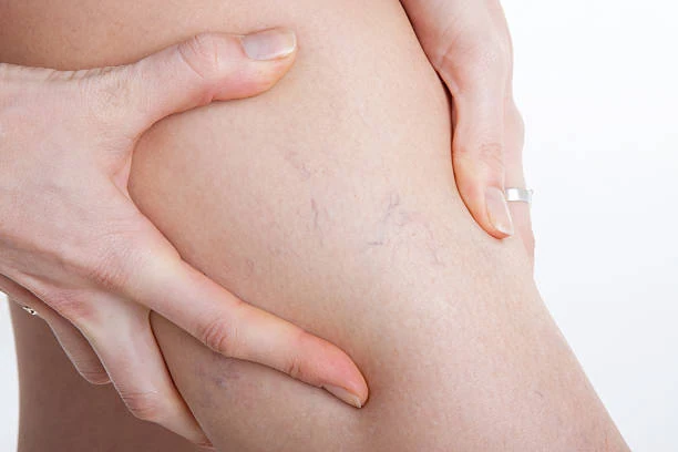Close-up of a hand on thigh with spider veins, showing vein disease symptoms.