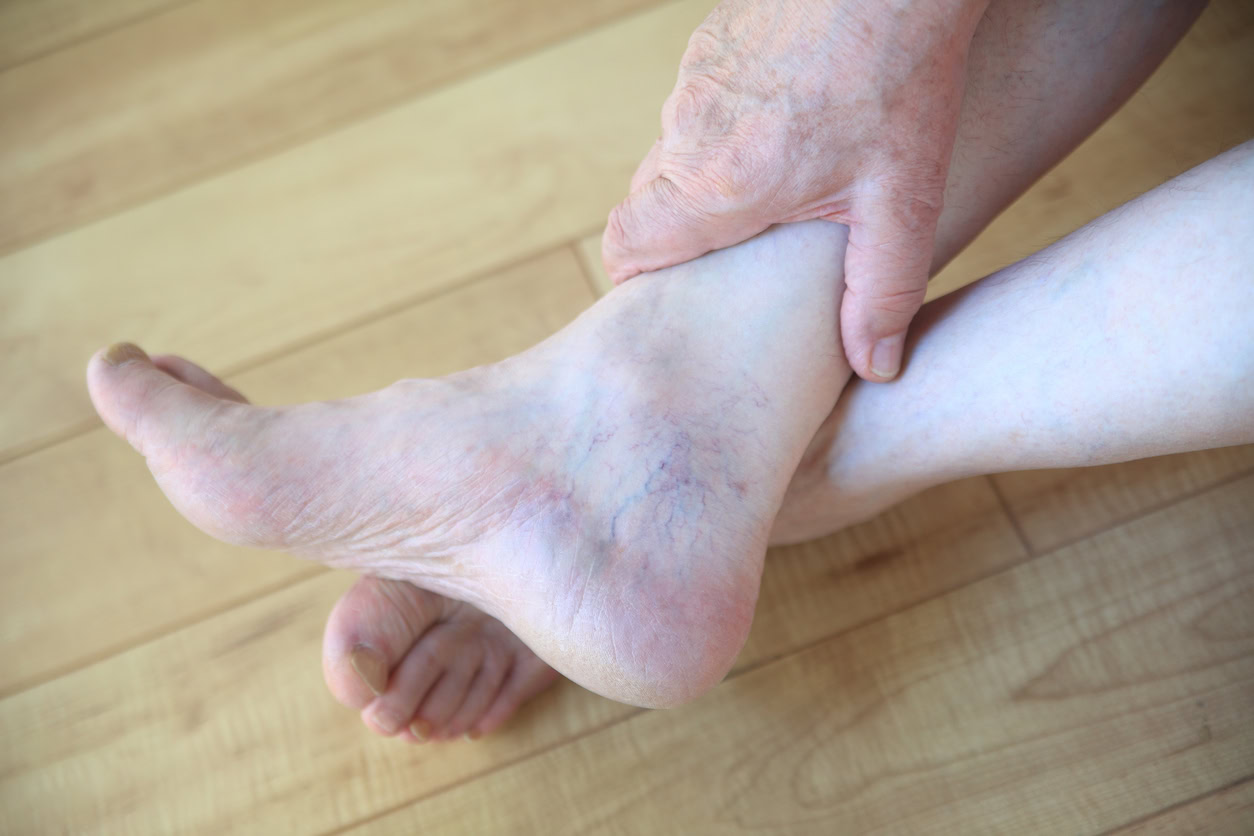 An elderly person with visible varicose veins sits at a Boca Raton vein treatment center.