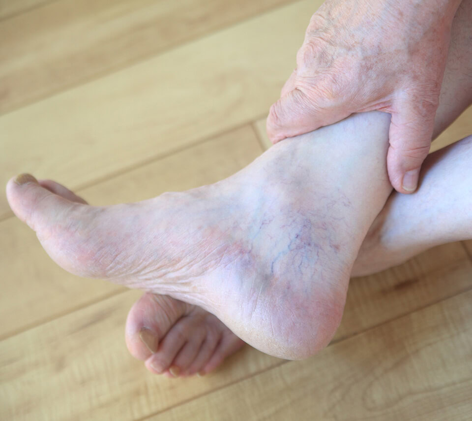 An older man with prominent veins on his foot