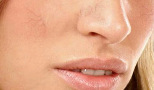 Close-up of lower face showing spider veins, a symptom for vein treatment in Boca Raton.