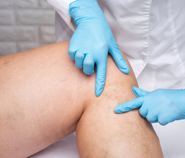 A vein specialist in Boca Raton examines varicose veins for vein treatment options.