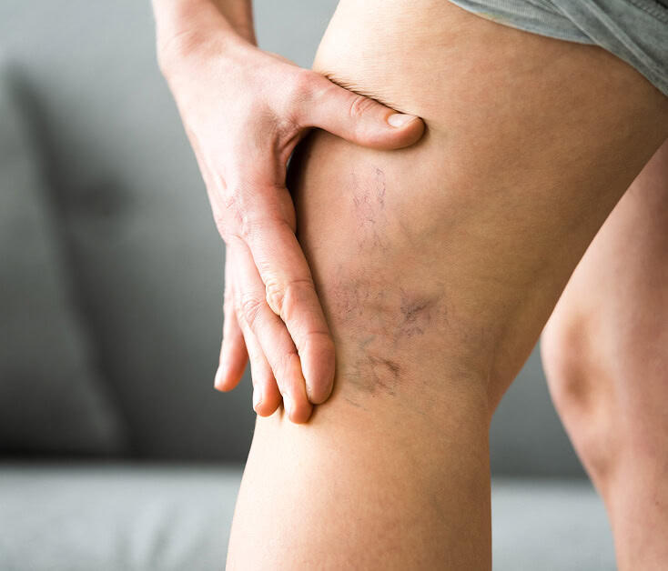 Person touches thigh showing vein disease symptoms at Boca Raton vein center.