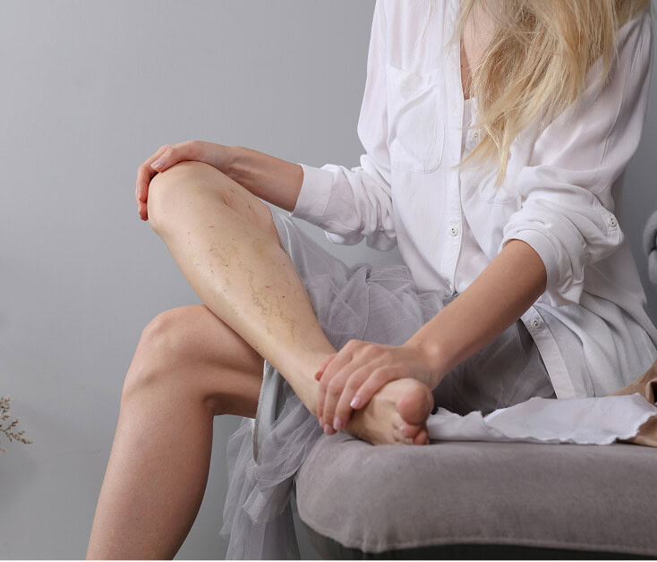 Woman with visible varicose veins consults at Boca Raton vein treatment center.