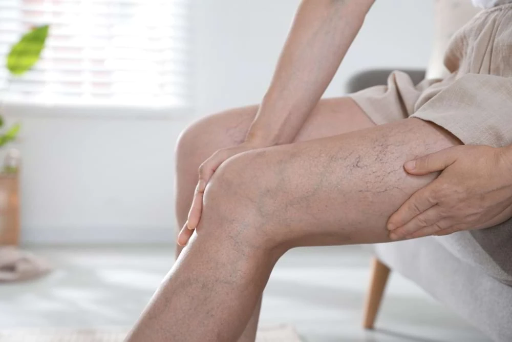 Person holding leg with visible varicose veins at Boca Raton vein treatment center.