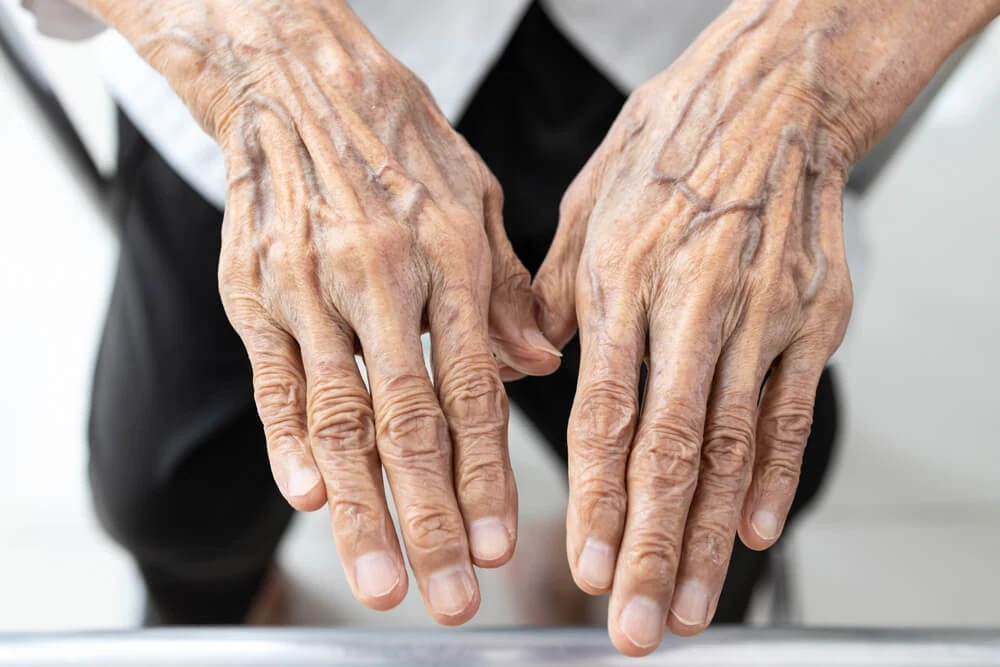 An older woman’s hands with varicose veins