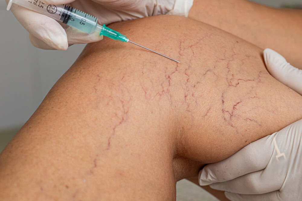 Various treatment options are available for visible veins