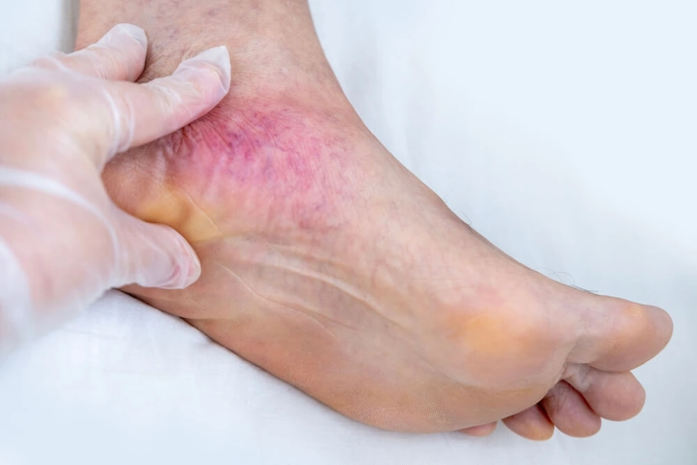 Bruising on the bottom of the foot appears as discoloration and swelling on the sole.