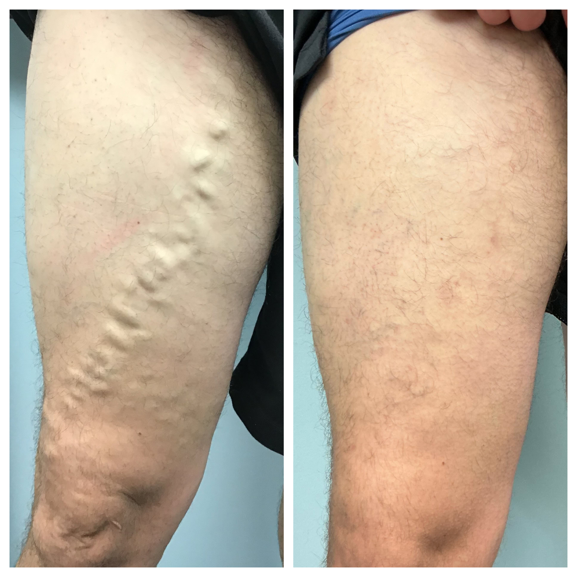 Boca Raton vein treatment center before and after varicose vein procedure comparison.