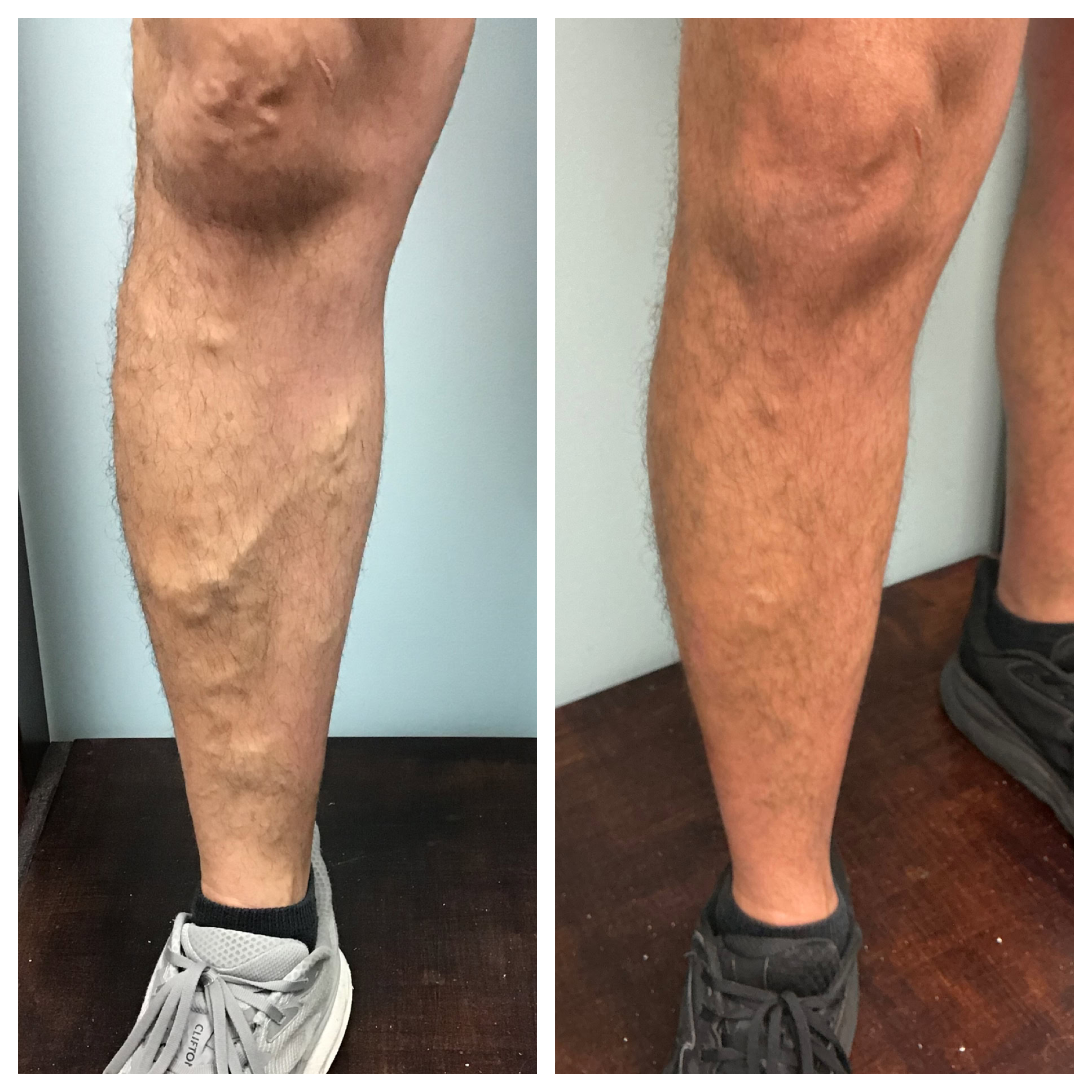 Before-and-after varicose vein treatment at Boca Raton vein center shows improved leg appearance and reduced vein disease symptoms.