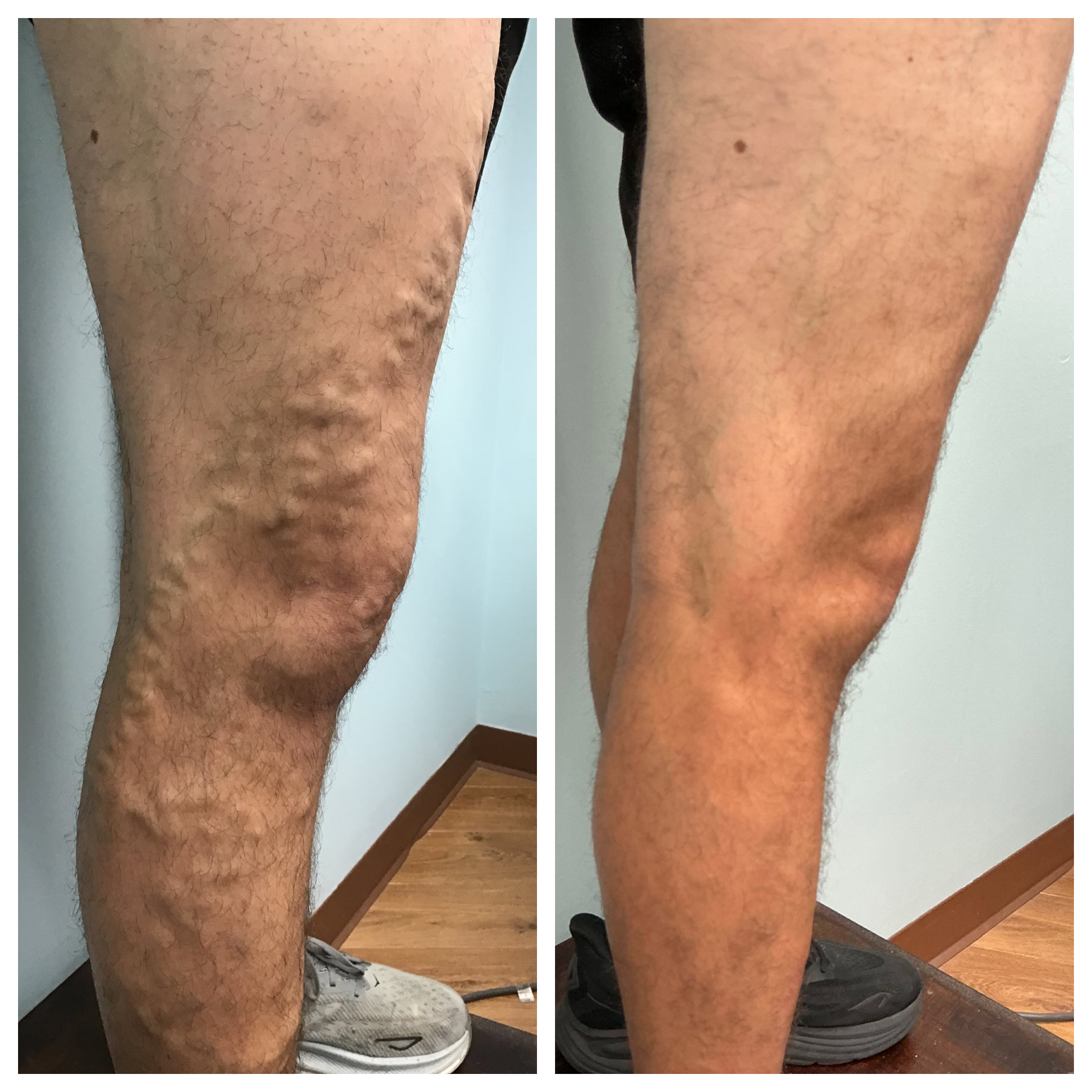 Before and after Boca Raton vein treatment center results for varicose vein reduction.