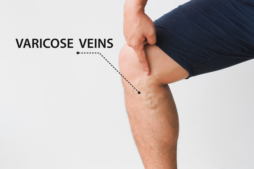 Healthy daily habits can support circulation and protect long-term vein health.