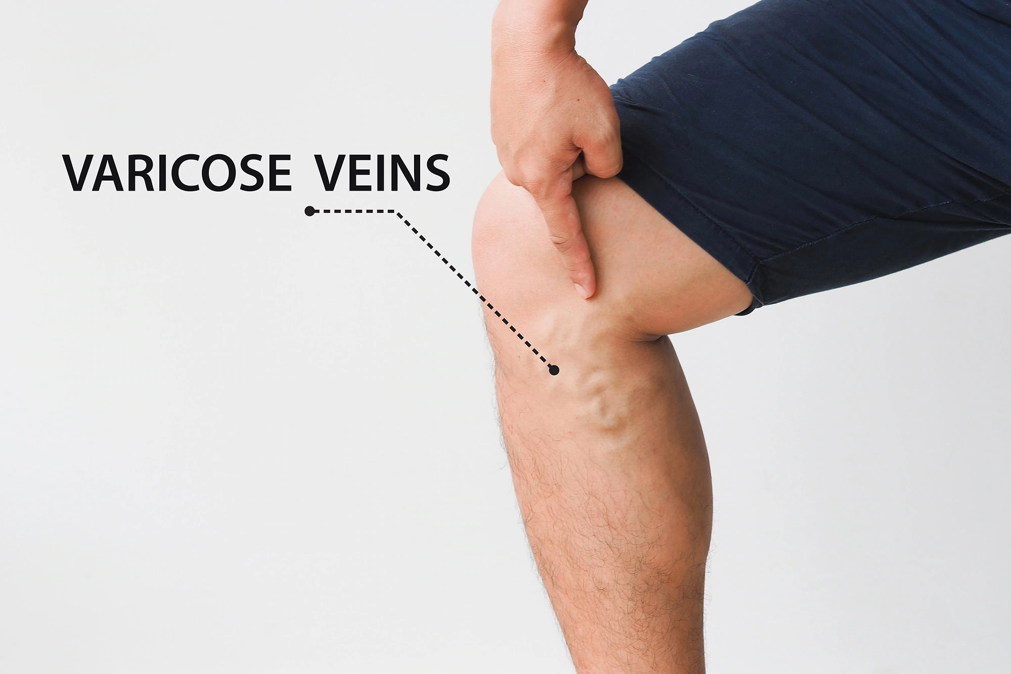 Healthy daily habits can support circulation and protect long-term vein health.