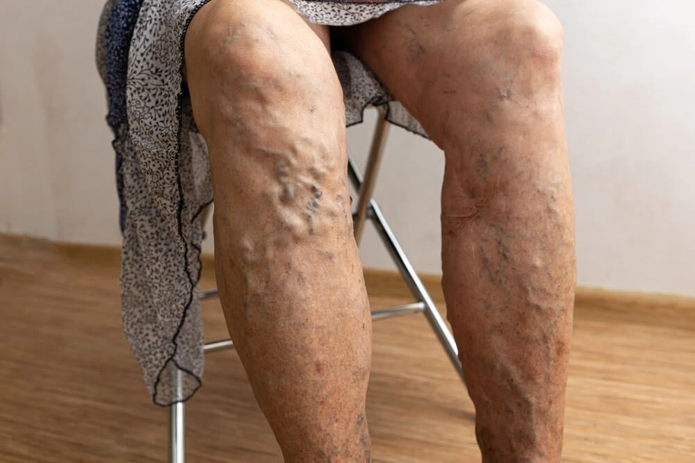 Varicose veins can cause discomfort, swelling, and heaviness in the legs.