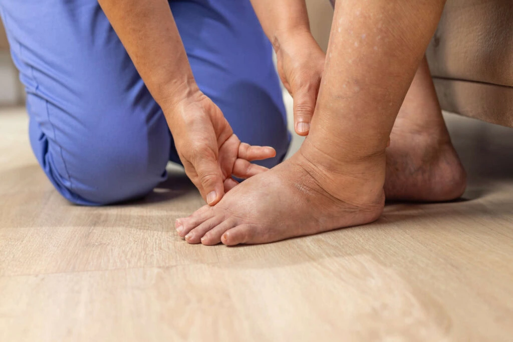 A vein specialist in Boca Raton examines a swollen foot for vein disease symptoms.