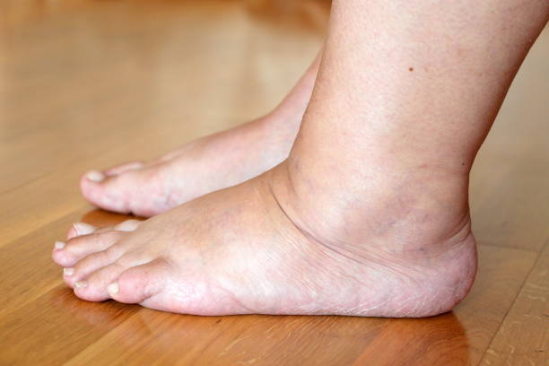 Swollen legs of an elderly woman. Bare feet filled with water and became heavy.
