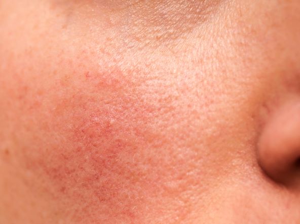 red spots rosacea on woman's face
