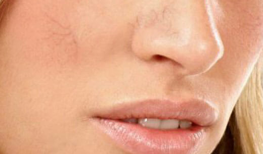 spider veins on woman's face