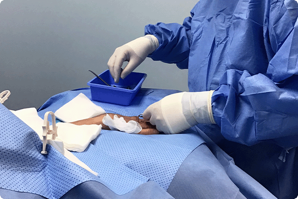 doctor completing varicose vein surgery on patient's hand