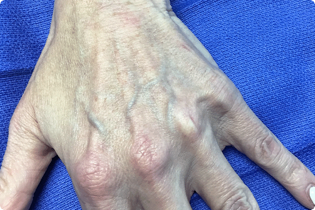 top of hand that has visible puffy veins